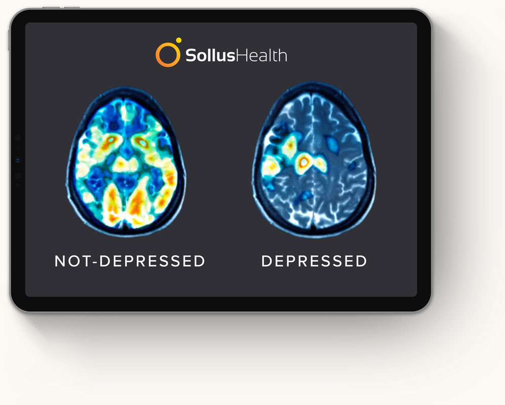 A scan showing brain activity of a depressed person and after taking tms therapy in san diego brain activity of a not-depressed person